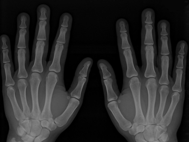 AI to aid doctors in spotting fractures on X-rays